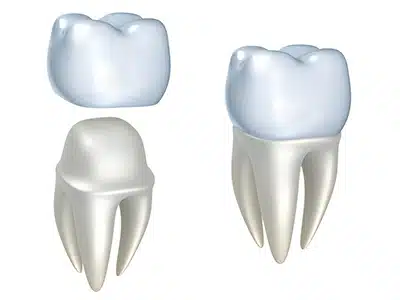 What are Zirconia Crowns and How are They Different from Other Crowns?