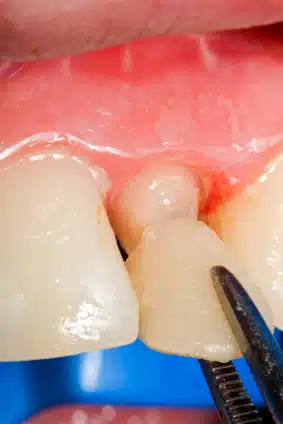 Veneers Are a Great Way to Cover Most Dental Imperfections